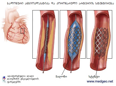 მწვავე კორონარული სინდრომი 3
