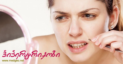 ჰიპერტრიქოზი