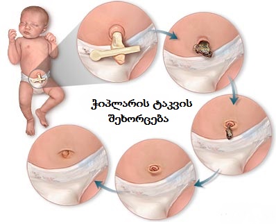 ახალშობილის ჭიპის მოვლა