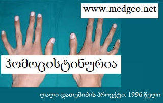 ჰომოცისტინურია ჰომოცისტინურია